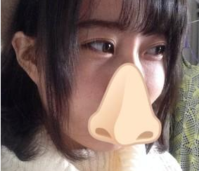 超声波去眼袋咋样啊?我来说说吧812 超声波去眼袋咋样啊?我来说说吧812