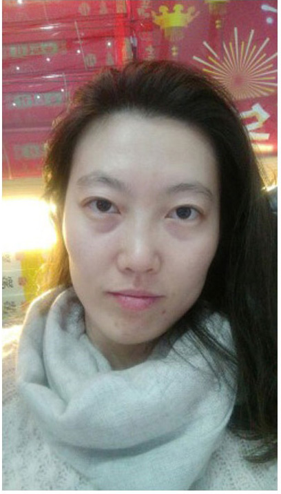 超 声 波去眼袋让wǒ美丽级le 超 声 波去眼袋让wǒ美丽级le