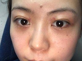 超声波去眼袋让我越来越精神了！787