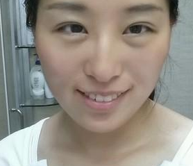 超声波去眼袋轻松无后遗症消除眼袋061 超声波去眼袋轻松无后遗症消除眼袋061