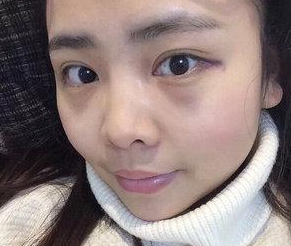 超声波去眼袋让眼袋就这么去掉了,好简单460 超声波去眼袋让眼袋就这么去掉了,好简单460