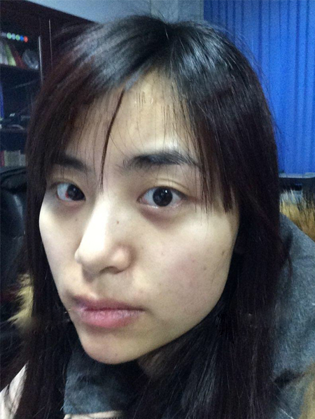 超声波祛眼袋一次性解决所有问题592 超声波祛眼袋一次性解决所有问题592