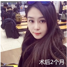 做le超 声 波瘦脸，总算把脸上得肥肉给瘦下去le