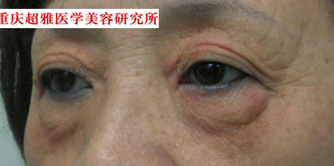 带老妈去做超声波去眼袋838 带老妈去做超声波去眼袋838