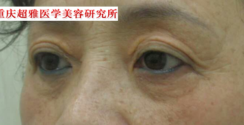 带老妈去做超声波去眼袋838 带老妈去做超声波去眼袋838