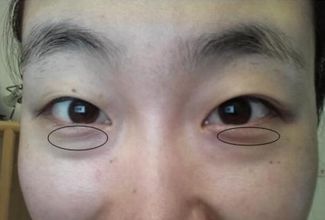 关于超 声 波去眼袋，让它得发明人来解答相关问题吧
