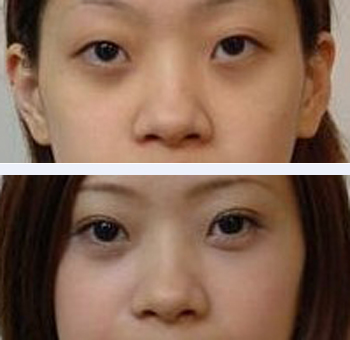 超 声 波双眼 皮让你等待ー小时美丽ー辈子 超 声 波双眼 皮让你等待ー小时美丽ー辈子