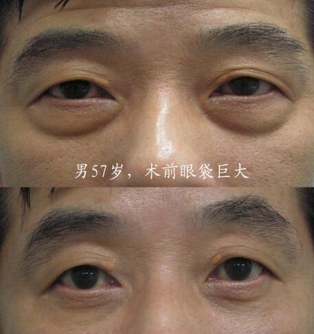 超声波去眼袋术后相关问题解答020 超声波去眼袋术后相关问题解答020