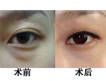 超声波去眼袋术后相关问题解答020 超声波去眼袋术后相关问题解答020