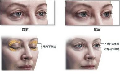 超声波去眼袋术后相关问题解答020 超声波去眼袋术后相关问题解答020