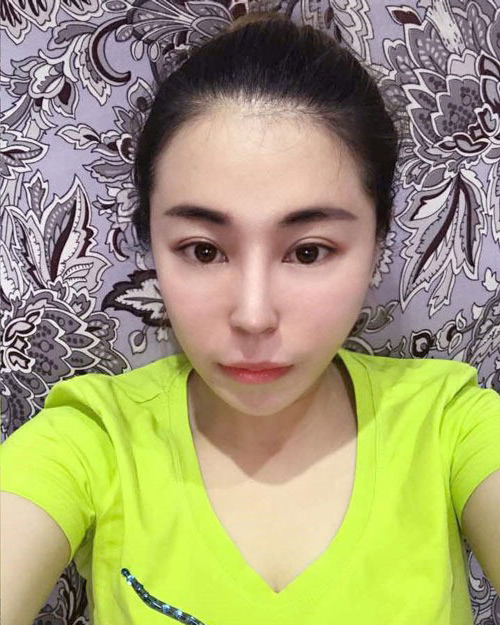 被电话骚扰让我长了眼袋，后来做了超声波去眼袋让我的眼袋没有了756