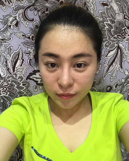 被电话骚扰让我长了眼袋，后来做了超声波去眼袋让我的眼袋没有了756