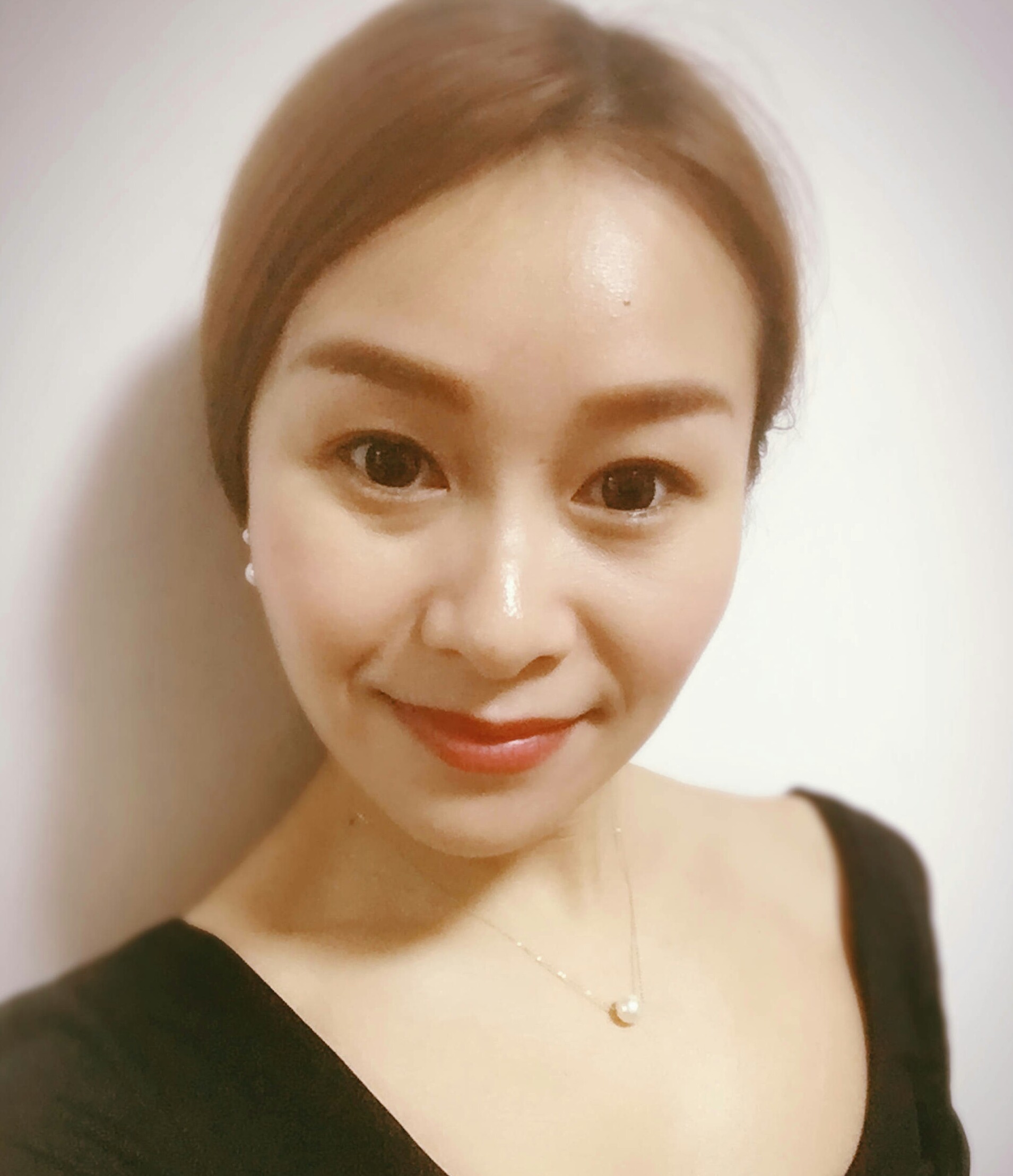 被调皮得女儿吵得wǒ睡不好觉长le眼袋，现在做超 声 波去眼袋让眼袋