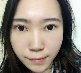 练习钢琴我长出了眼袋，现在做了超声波祛眼袋手术以后眼袋没有了159