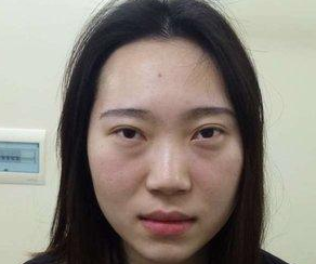 练习钢琴我长出了眼袋，现在做了超声波祛眼袋手术以后眼袋没有了159
