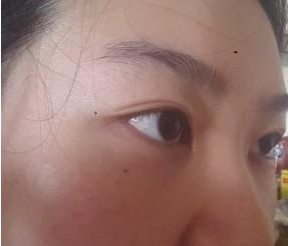 眼睛下方的小囊袋被超声波去眼袋解决啦662 眼睛下方的小囊袋被超声波去眼袋解决啦662