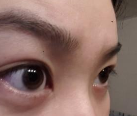 眼睛下方的小囊袋被超声波去眼袋解决啦662 眼睛下方的小囊袋被超声波去眼袋解决啦662