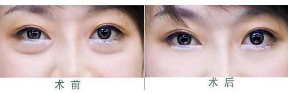 超声波去眼袋是科学消除眼袋保护眼睛的绝佳眼袋术870