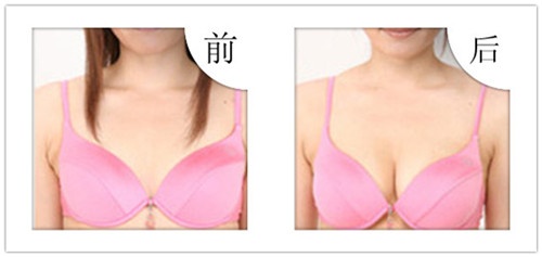 超声波丰胸技术解救更多的平胸妹039 超声波丰胸技术解救更多的平胸妹039