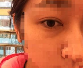 重庆超雅得梁医生用超 声 波去眼袋帮wǒ消除眼袋le