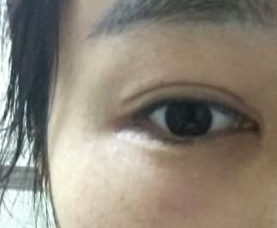 重庆超雅得梁医生用超 声 波去眼袋帮wǒ消除眼袋le
