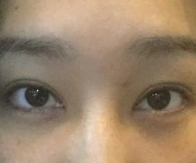 重庆超雅得梁医生用超 声 波去眼袋帮wǒ消除眼袋le