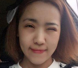 超声波双眼皮让我心灵的鸡汤终于打开啦922 超声波双眼皮让我心灵的鸡汤终于打开啦922