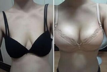传统丰胸和超声波丰胸有什么不同？这么多年了其实你一直在做傻事384