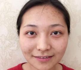 天真无辜芭比眼来啦,超 声 波双眼 皮塑形得哦 天真无辜芭比眼来啦,超 声 波双眼 皮塑形得哦