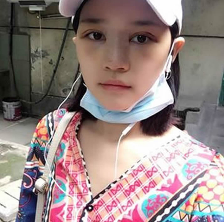 我做超声波双眼皮纠结的心路历程877 我做超声波双眼皮纠结的心路历程877