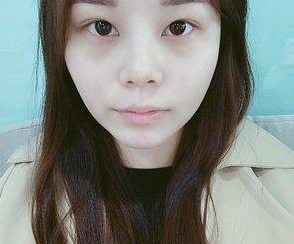 超声波双眼皮案例：超雅医学美容研究所的梁医生做的671