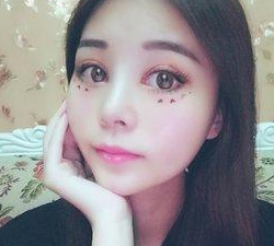 超声波双眼皮案例：超雅医学美容研究所的梁医生做的671