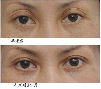超 声 波双眼 皮为什么如此受欢迎? 超 声 波双眼 皮为什么如此受欢迎?