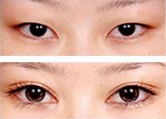 超 声 波双眼 皮为什么如此受欢迎? 超 声 波双眼 皮为什么如此受欢迎?