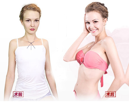 微创伤效果好：初次之外超声波丰胸的优势你知道吗？253