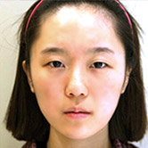 超声波双眼皮替代传统技术，成为符合当时代最为先进的技术957
