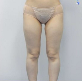 超声波减肥后终于可以穿S码的裤子了!225 超声波减肥后终于可以穿S码的裤子了!225