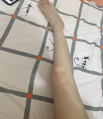 超声波减肥后终于可以穿S码的裤子了!225 超声波减肥后终于可以穿S码的裤子了!225