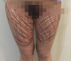 大腿粗到没谁，小腿细到没谁，超 声 波减肥来拯救wǒ吧！