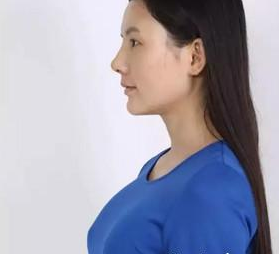不再平胸后穿衣服也有女人味了，多亏了超声波自体脂肪丰胸000