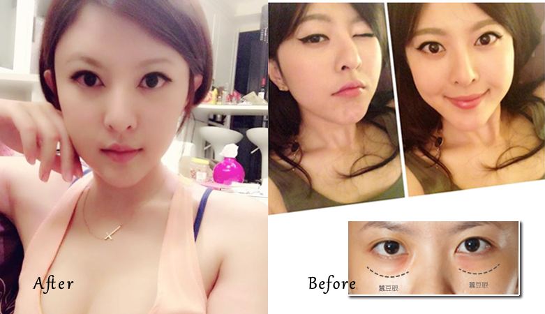 超声波去眼袋发明人为你解答去眼袋的那些事儿495 超声波去眼袋发明人为你解答去眼袋的那些事儿495