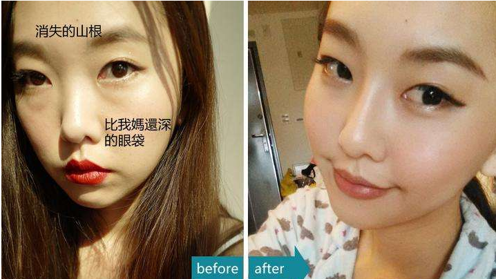 超声波去眼袋发明人为你解答去眼袋的那些事儿495 超声波去眼袋发明人为你解答去眼袋的那些事儿495