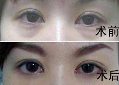 超声波去眼袋发明人为你解答去眼袋的那些事儿495 超声波去眼袋发明人为你解答去眼袋的那些事儿495
