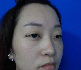 精细超声波双眼皮,真的超自然的219 精细超声波双眼皮,真的超自然的219