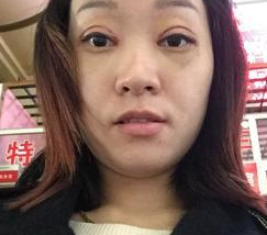 精细超声波双眼皮,真的超自然的219 精细超声波双眼皮,真的超自然的219