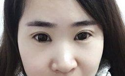 短而圆的眼睛太适合做超声波双眼皮了!652 短而圆的眼睛太适合做超声波双眼皮了!652