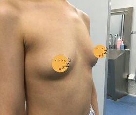 24年的老店——重庆超雅的超声波自体脂肪丰胸效果真棒！339