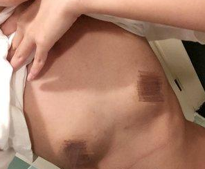 超声波自体脂肪丰胸让胸前一两肉变四两237 超声波自体脂肪丰胸让胸前一两肉变四两237