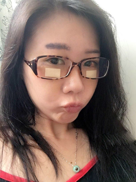 超声波祛眼袋,梁医生为长期困扰患者带来佳音749 超声波祛眼袋,梁医生为长期困扰患者带来佳音749