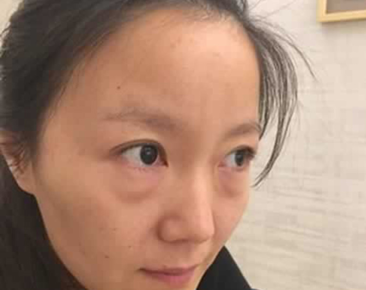 超声波祛眼袋确保永不复发202 超声波祛眼袋确保永不复发202